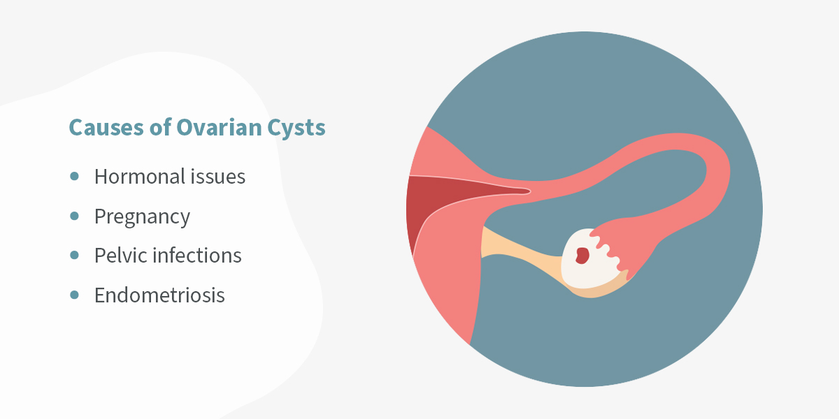 Causes of Ovarian Cysts